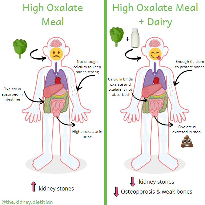 Cartoon showing that eating high oxalate foods by themselves results in more oxalate getting absorbed and a higher risk of kidney stones.  When paired with dairy, oxalate is excreted in stool and there is a reduced risk of kidney stones