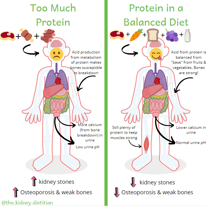 Cartoon showing that eating lots of meat will increase urine calcium and lower urine pH, increasing the risk of kidney stones.  Protein in a balanced diet will help promote a healthy urine pH and still provide enough protein for muscle health.