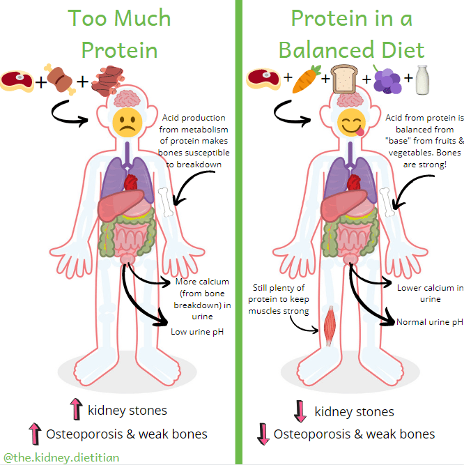 Cartoon showing that eating lots of meat will increase urine calcium and lower urine pH, increasing the risk of kidney stones. Protein in a balanced diet will help promote a healthy urine pH and still provide enough protein for muscle health.