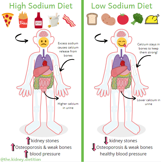 Cartoon showing that eating salty foods like pizza, fries, ketchup, Chinese food and bacon causes more urine calcium and a higher risk of kidney stones.