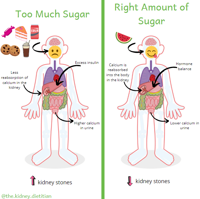 Cartoon showing that eating lots of sweets causes excess insulin production, which results in more urine calcium and higher risk of kidney stones.